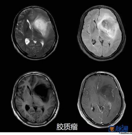 脑转移瘤的诊断与鉴别诊断 脑转移瘤的诊断与鉴别诊断