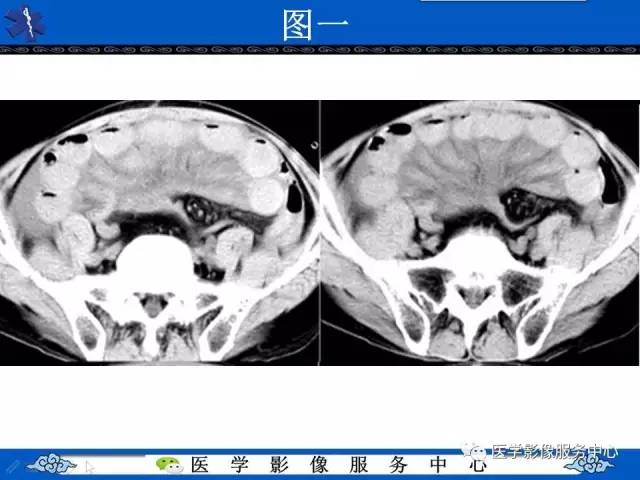 【影像征象】车轮征——小肠扭转