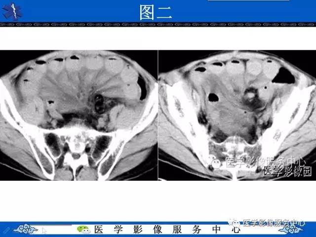 【影像征象】车轮征——小肠扭转