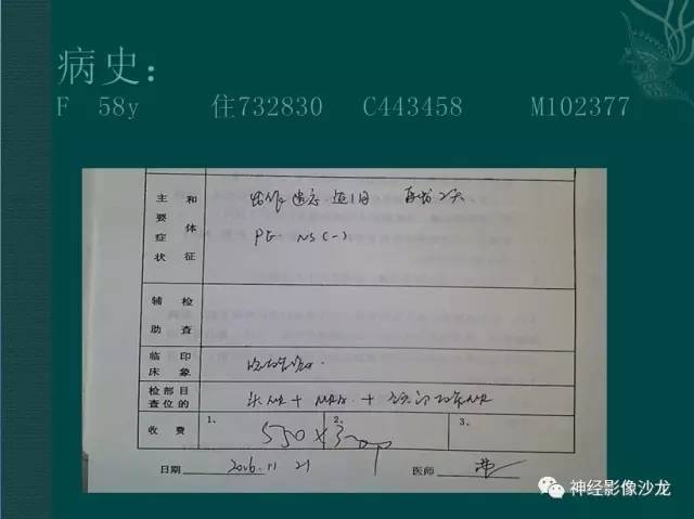 【病例】右侧脑室脑膜瘤1例CT及MR影像表现