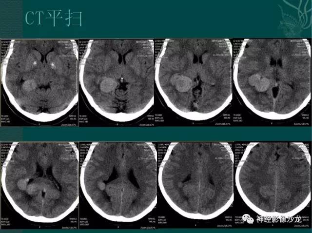 【病例】右侧脑室脑膜瘤1例CT及MR影像表现 【病例】右侧脑室脑膜瘤1例CT及MR影像表现
