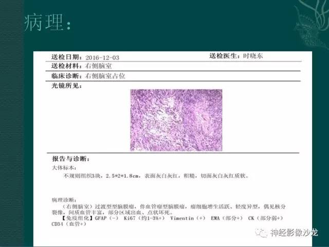 【病例】右侧脑室脑膜瘤1例CT及MR影像表现 【病例】右侧脑室脑膜瘤1例CT及MR影像表现