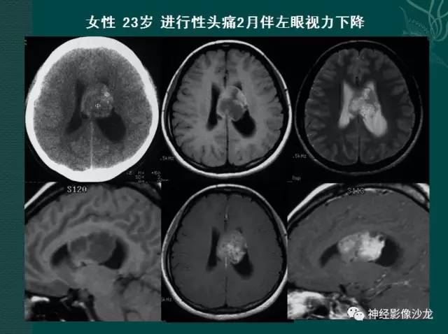 【病例】右侧脑室脑膜瘤1例CT及MR影像表现 【病例】右侧脑室脑膜瘤1例CT及MR影像表现