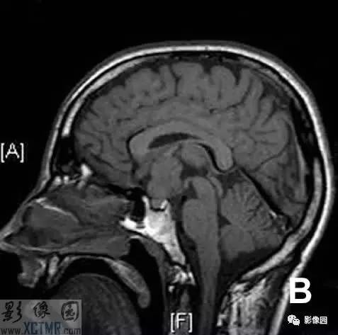 【病例】鞍上脊索样胶质瘤1例MRI影像诊断分析 【病例】鞍上脊索样胶质瘤1例MRI影像诊断分析