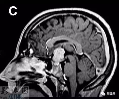 【病例】鞍上脊索样胶质瘤1例MRI影像诊断分析 【病例】鞍上脊索样胶质瘤1例MRI影像诊断分析