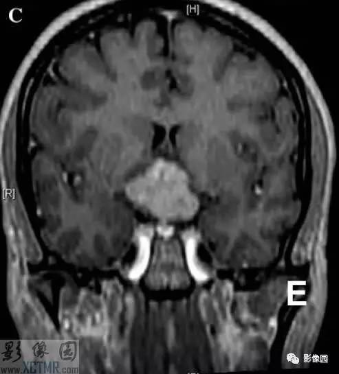 【病例】鞍上脊索样胶质瘤1例MRI影像诊断分析 【病例】鞍上脊索样胶质瘤1例MRI影像诊断分析