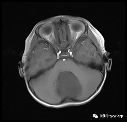 【病例】四脑室室管膜瘤1例MR影像表现 【病例】四脑室室管膜瘤1例MR影像表现
