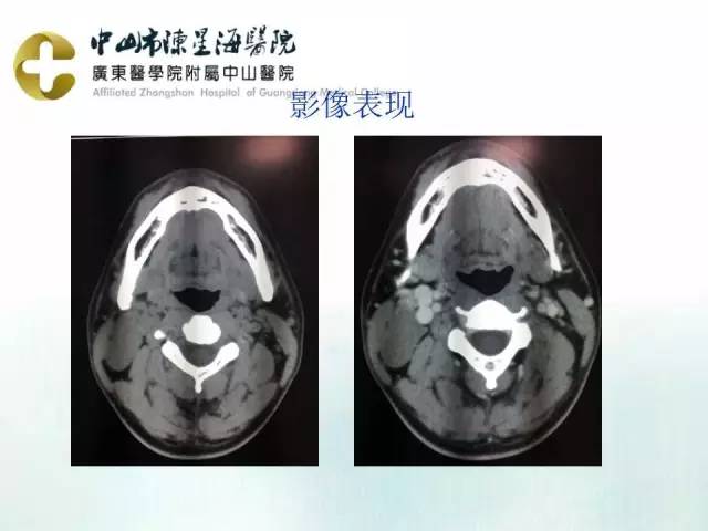 【PPT】鳃裂囊肿影像表现