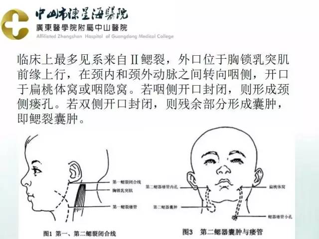 【PPT】鳃裂囊肿影像表现