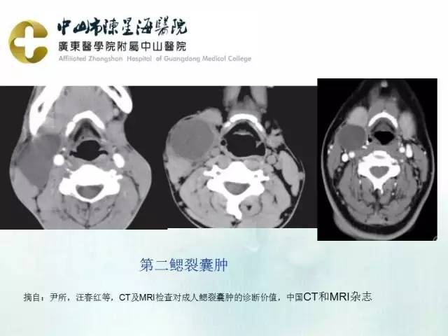 【PPT】鳃裂囊肿影像表现