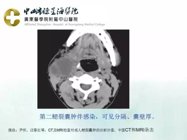 【PPT】鳃裂囊肿影像表现