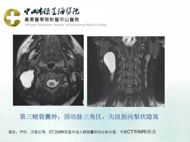 【PPT】鳃裂囊肿影像表现