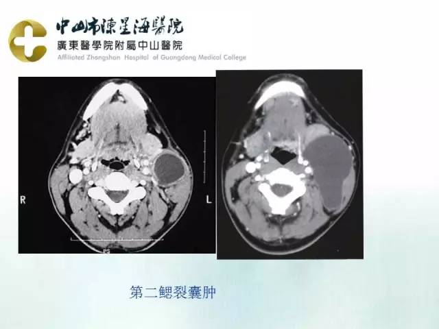 【PPT】鳃裂囊肿影像表现