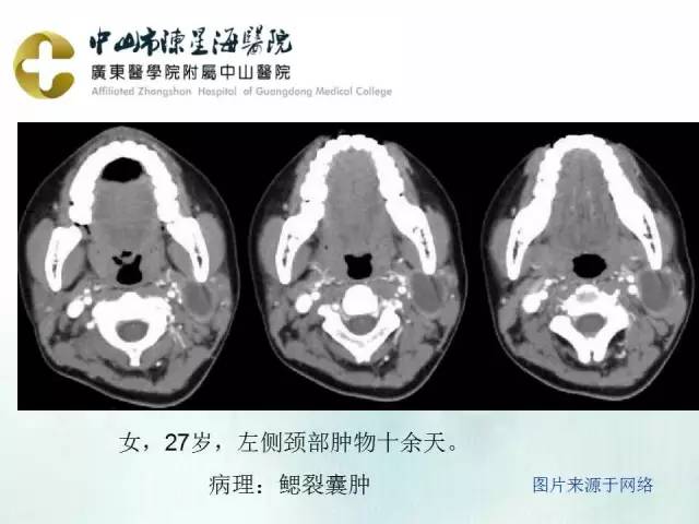 【PPT】鳃裂囊肿影像表现