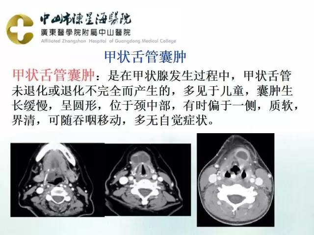 【PPT】鳃裂囊肿影像表现