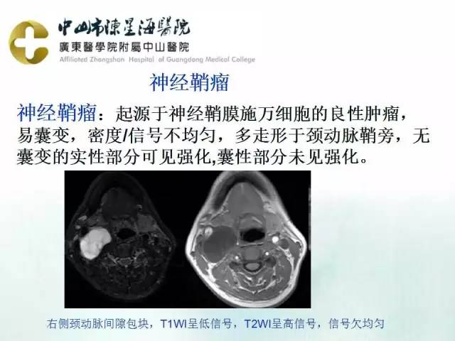【PPT】鳃裂囊肿影像表现
