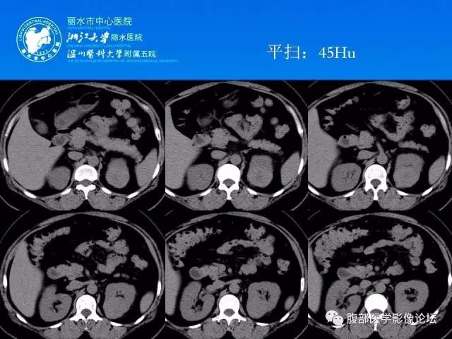 【病例】左肾嗜酸细胞腺瘤1例CT影像表现