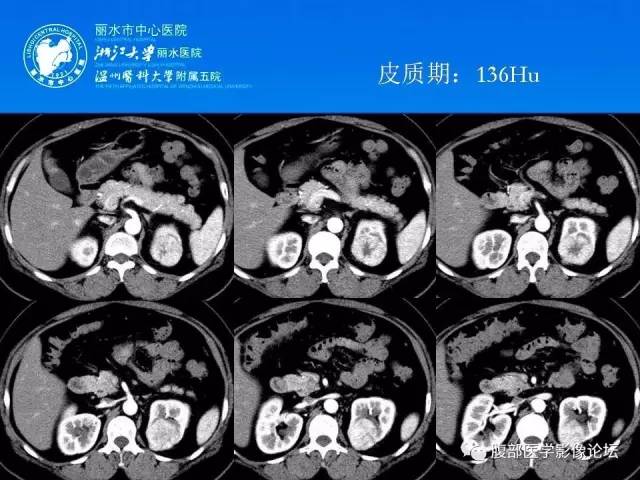 【病例】左肾嗜酸细胞腺瘤1例CT影像表现 【病例】左肾嗜酸细胞腺瘤1例CT影像表现