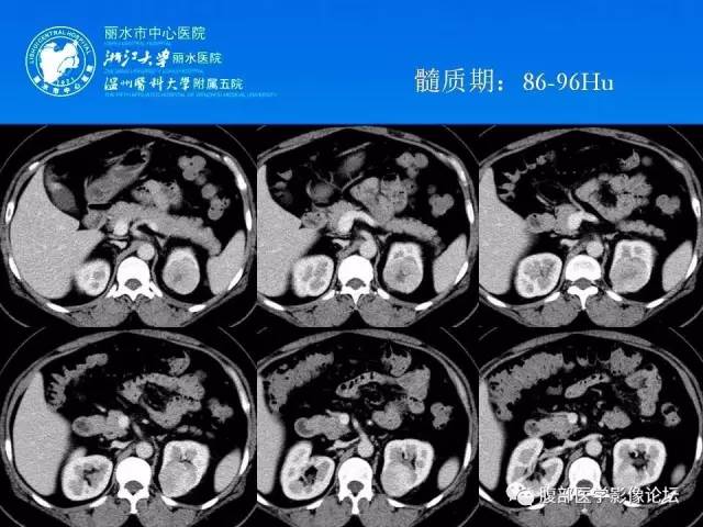 【病例】左肾嗜酸细胞腺瘤1例CT影像表现 【病例】左肾嗜酸细胞腺瘤1例CT影像表现
