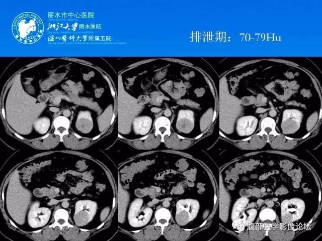 【病例】左肾嗜酸细胞腺瘤1例CT影像表现 【病例】左肾嗜酸细胞腺瘤1例CT影像表现