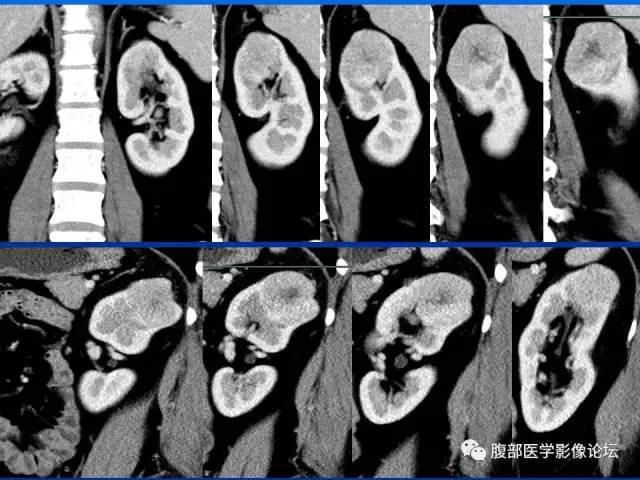 【病例】左肾嗜酸细胞腺瘤1例CT影像表现 【病例】左肾嗜酸细胞腺瘤1例CT影像表现