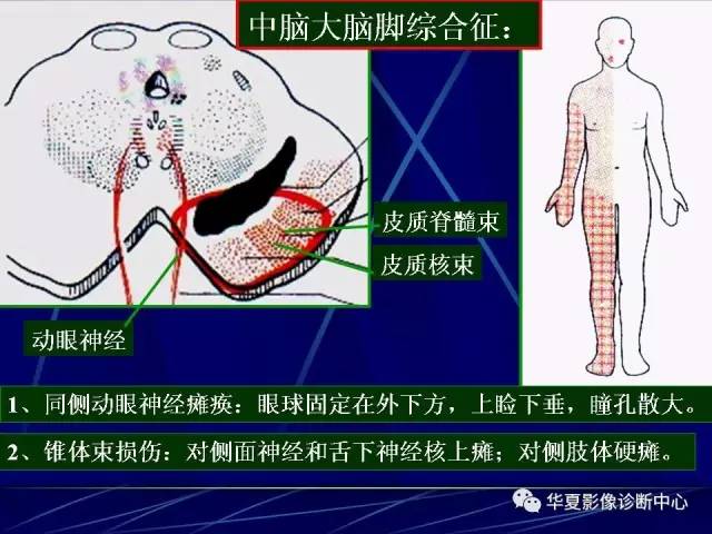 脑干解剖复习