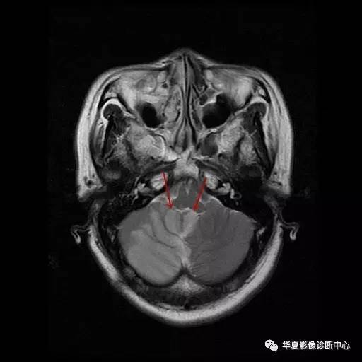 箭头所示急性脑梗，你能准确说出解剖定位吗？