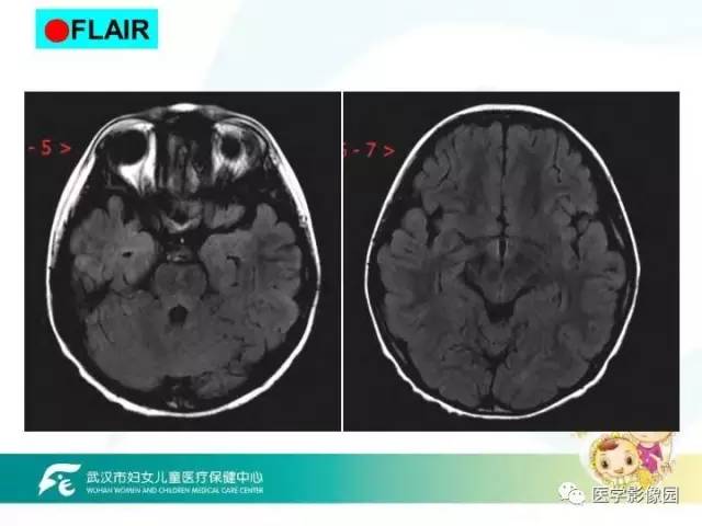 【PPT】小儿NMOSD及其相关疾病MRI诊断思路