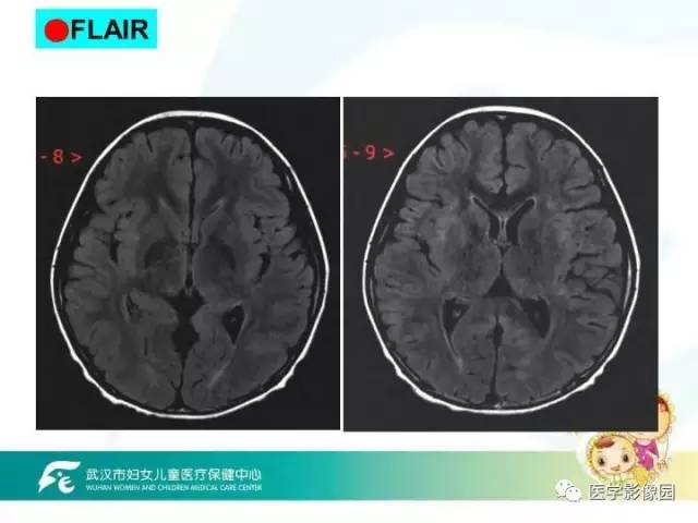 【PPT】小儿NMOSD及其相关疾病MRI诊断思路
