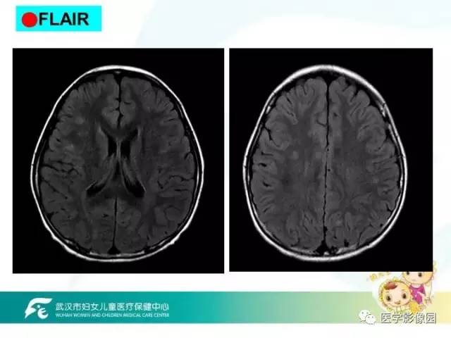 【PPT】小儿NMOSD及其相关疾病MRI诊断思路