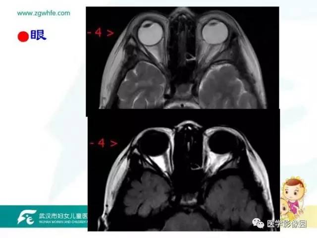 【PPT】小儿NMOSD及其相关疾病MRI诊断思路