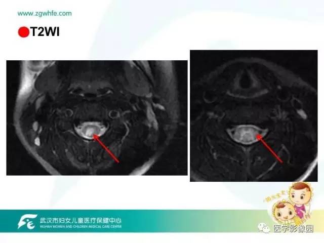 【PPT】小儿NMOSD及其相关疾病MRI诊断思路