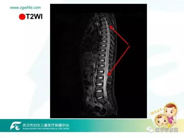 【PPT】小儿NMOSD及其相关疾病MRI诊断思路