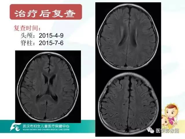 【PPT】小儿NMOSD及其相关疾病MRI诊断思路