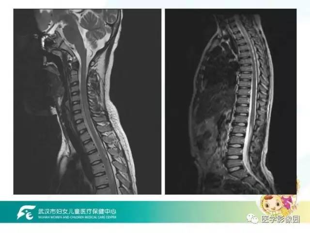 【PPT】小儿NMOSD及其相关疾病MRI诊断思路