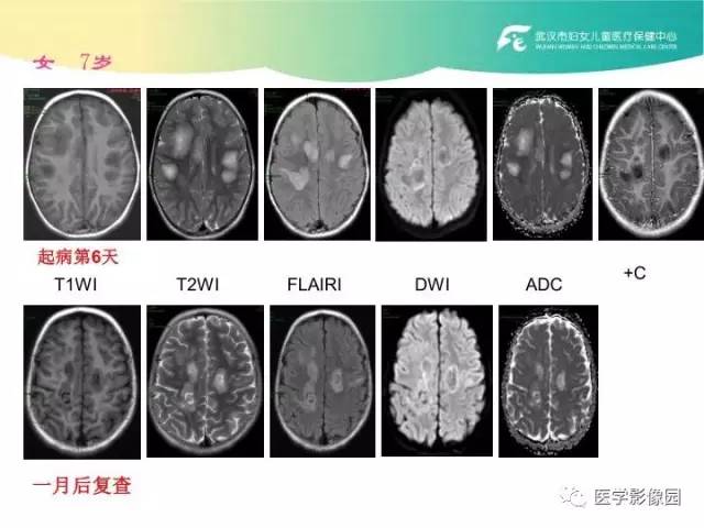 【PPT】小儿NMOSD及其相关疾病MRI诊断思路