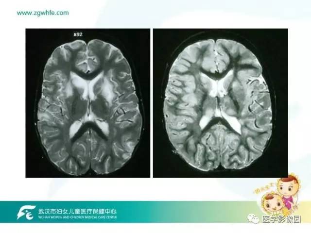 【PPT】小儿NMOSD及其相关疾病MRI诊断思路