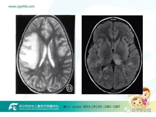 【PPT】小儿NMOSD及其相关疾病MRI诊断思路