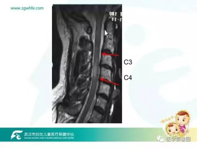 【PPT】小儿NMOSD及其相关疾病MRI诊断思路
