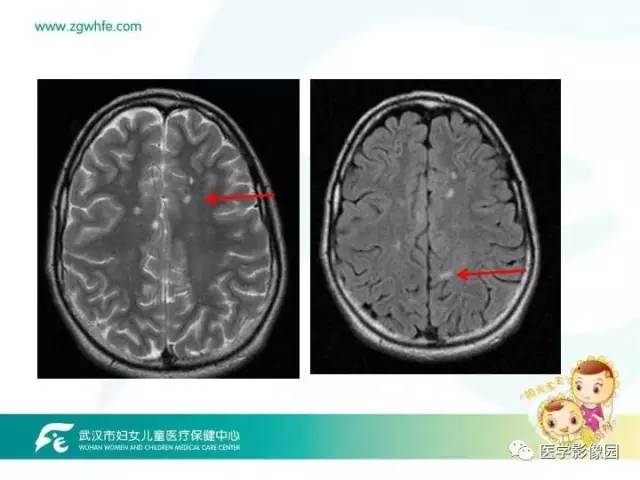【PPT】小儿NMOSD及其相关疾病MRI诊断思路