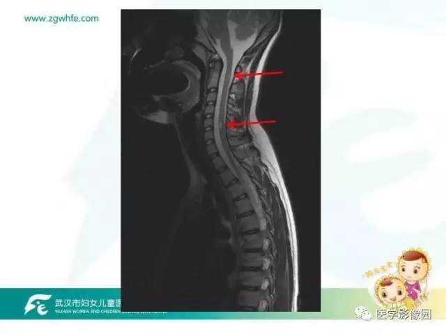 【PPT】小儿NMOSD及其相关疾病MRI诊断思路
