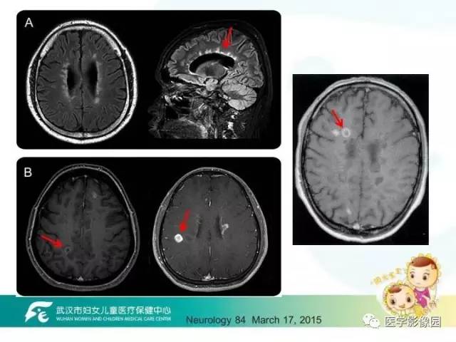 【PPT】小儿NMOSD及其相关疾病MRI诊断思路