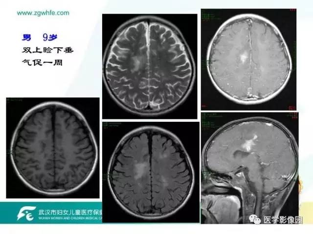 【PPT】小儿NMOSD及其相关疾病MRI诊断思路