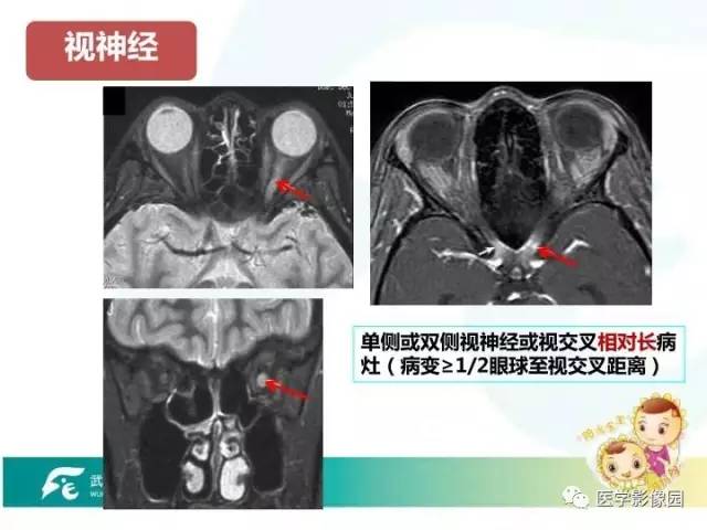 【PPT】小儿NMOSD及其相关疾病MRI诊断思路