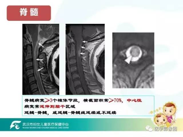 【PPT】小儿NMOSD及其相关疾病MRI诊断思路