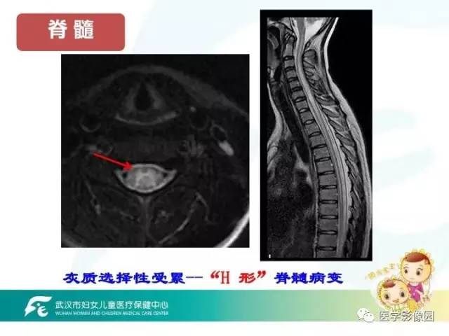 【PPT】小儿NMOSD及其相关疾病MRI诊断思路