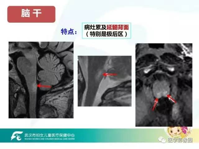 【PPT】小儿NMOSD及其相关疾病MRI诊断思路