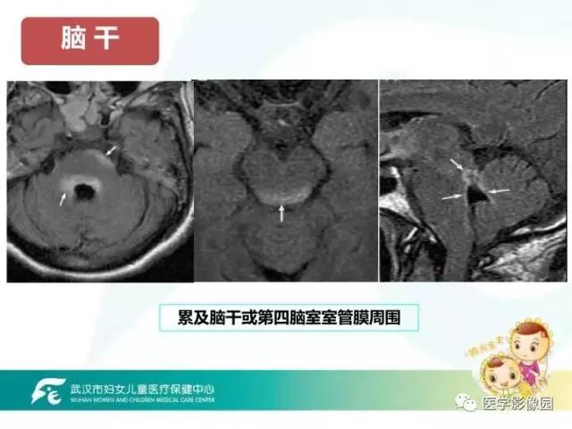 【PPT】小儿NMOSD及其相关疾病MRI诊断思路