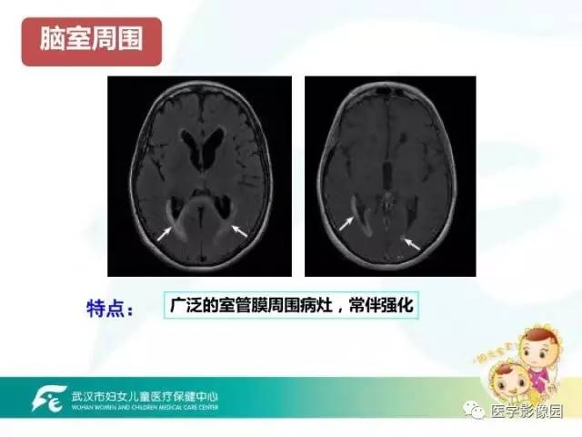 【PPT】小儿NMOSD及其相关疾病MRI诊断思路