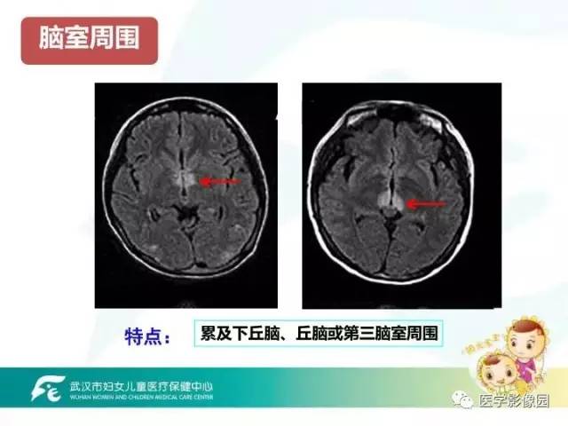 【PPT】小儿NMOSD及其相关疾病MRI诊断思路